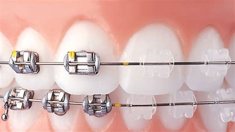 brackets de porcelana y metalicos|Brackets Cerámicos Y Metálicos: 7 Puntos De .